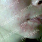 脸部皮肤过敏