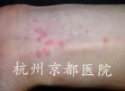 荨麻疹的病因,温州华医堂皮肤病专科