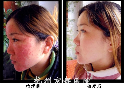 痤疮的治疗,温州华医堂皮肤病专科