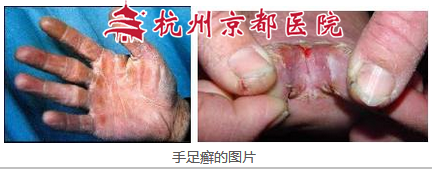 手足癣